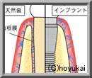インプラントとは?
